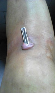 Image for article Dafa’nın Gücü: 22 Yıl Önce Bacağıma Yerleştirilen Çelik Mil, Ameliyat Olmadan Çıktı
